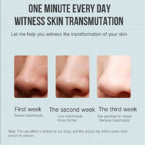 電気抽出機にきびの除去黒毛の除去剤の真空の美機械の穴のクリーナー