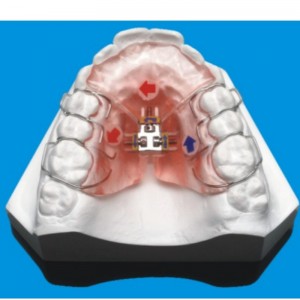 歯列矯正シリーズ